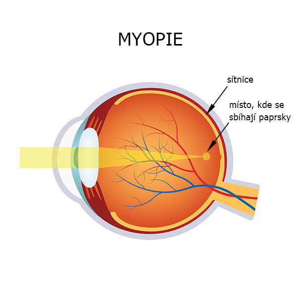 schéma krátkozrakého oka